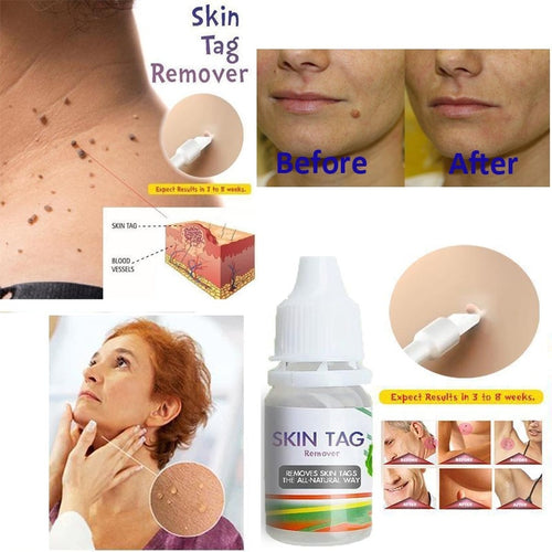 10ml Body Warts Corn Mole Genital Wart Treatment Cream Skin Tag Remover Plantar Genital Warts Ointment Foot Care Cream